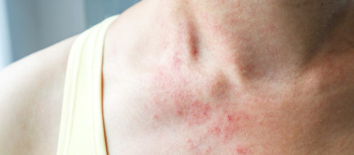 Comment traiter l’eczéma ?